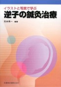 イラストと写真で学ぶ　逆子の鍼灸治療