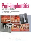 Peri－implantitis　インプラント周囲炎