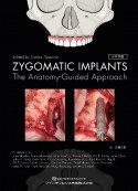 ZYGOMATIC　IMPLANTS　日本語版　The　AnatomyーGuided　Approach